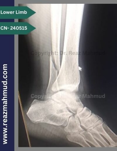 Lateral malleolus preoperative