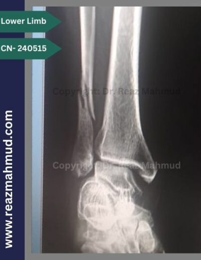 Lateral malleolus preoperative 1